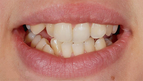 Зубы до ортодонтии